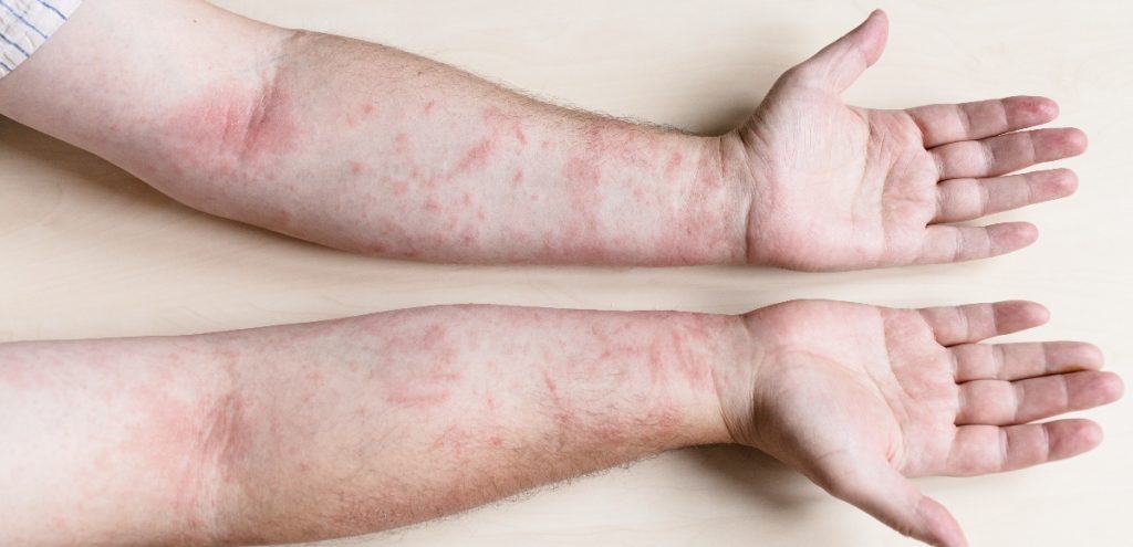 artrite psoriasica