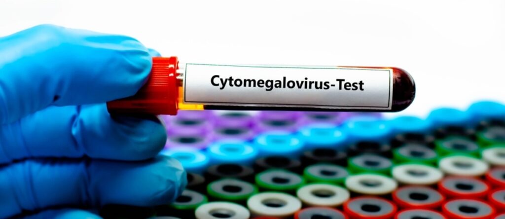 citomegalovirus santagostino busto arsizio