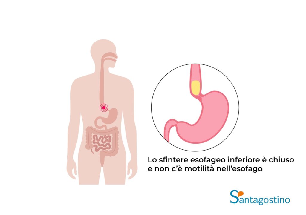 Acalasia anatomia santagostino busto arsizio