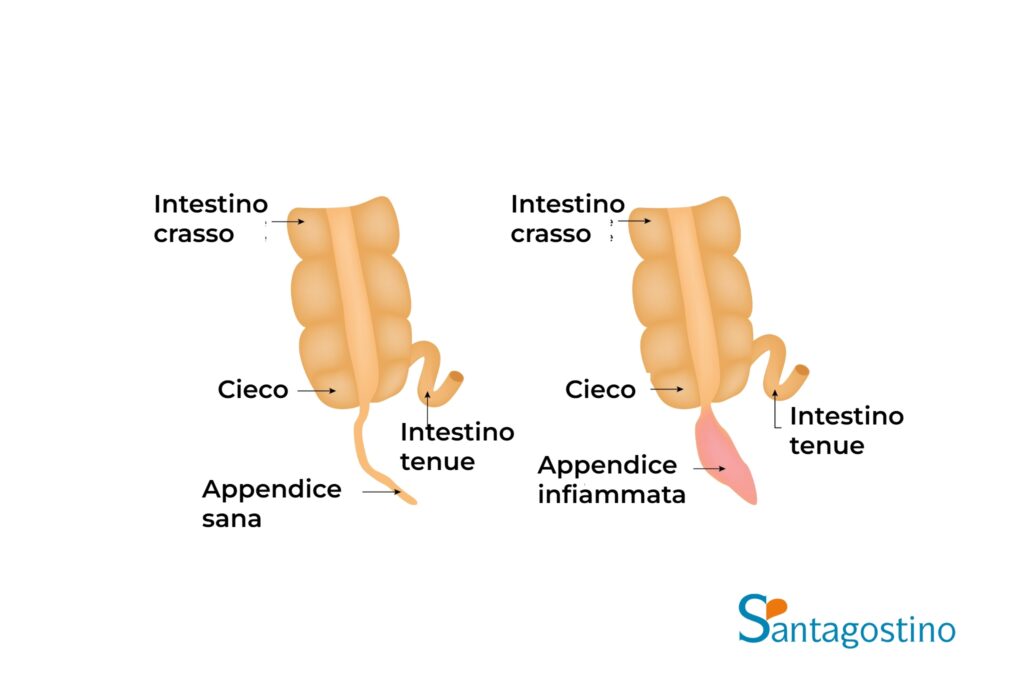 anatomia appendice santagostino busto arsizio
