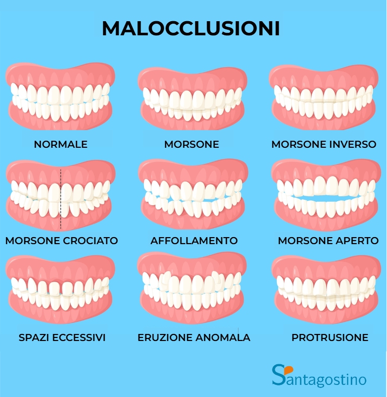 malocclusioni santagostino busto arsizio