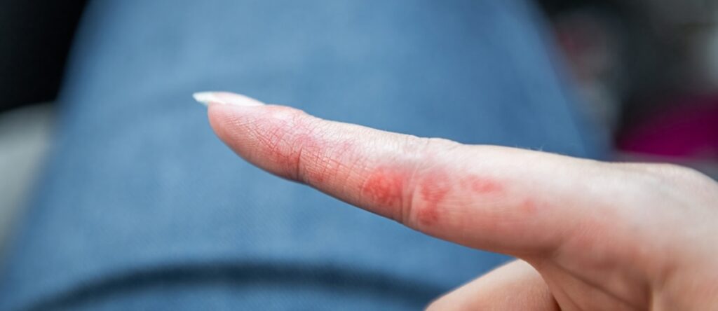 allergia nichel santagostino busto arsizio