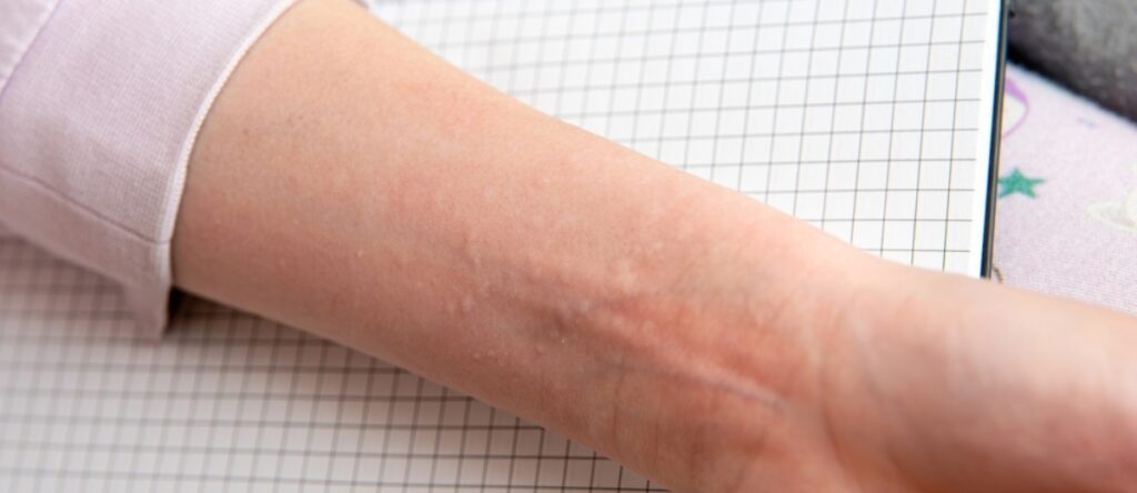 orticaria santagostino busto arsizio