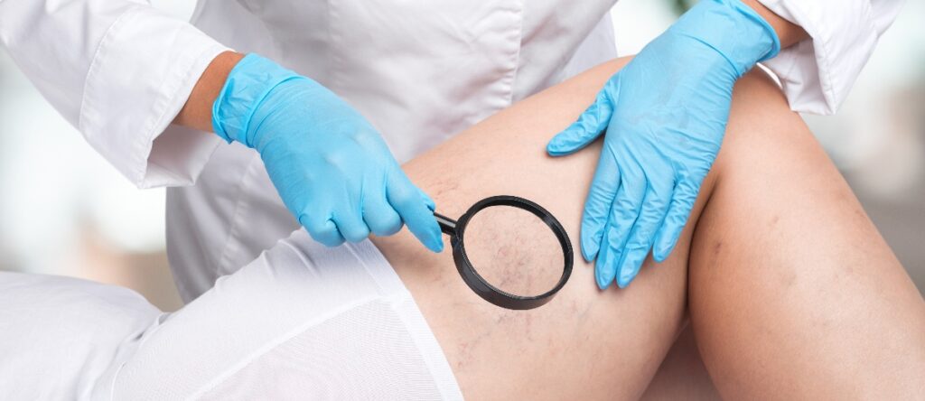 insufficienza venosa santagostino busto arsizio