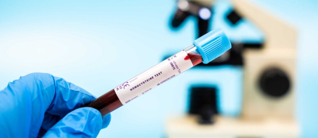 omocisteina santagostino busto arsizio