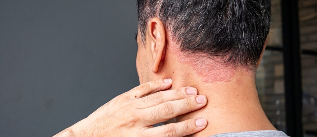 psoriasi santagostino busto arsizio