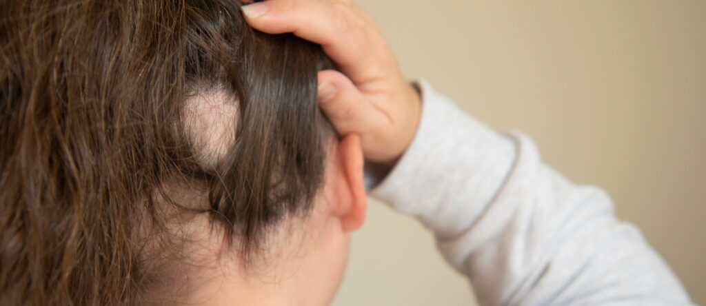 alopecia santagostino busto arsizio